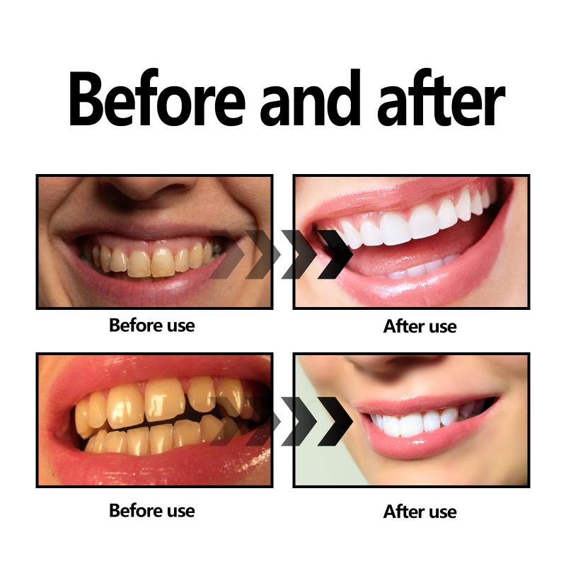 مسحوق تبييض الأسنان فحمي/صودا  - مراجعة Teeth Whitening Charcoal Powder وسعره