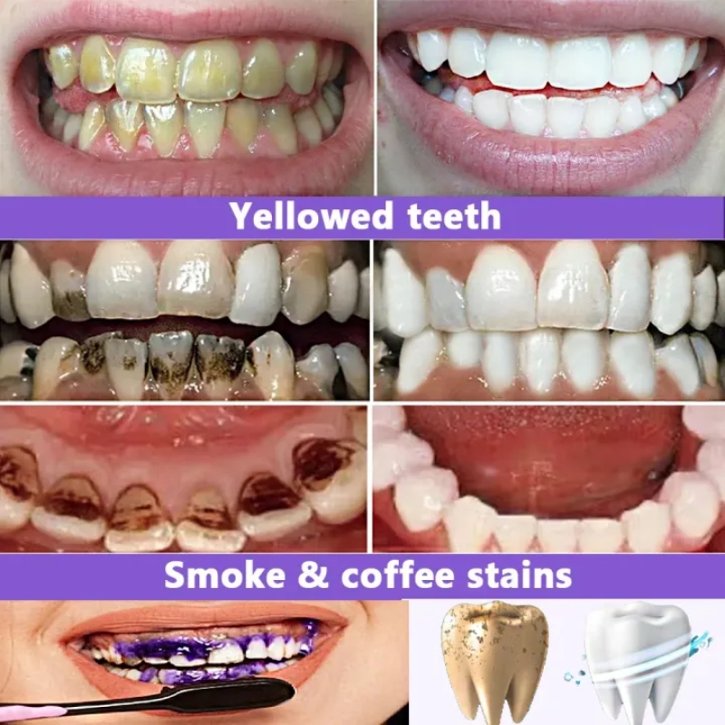 معجون أسنان مبيض الأكثر مبيعًا - مراجعة Teeth Whitening Effective وسعره