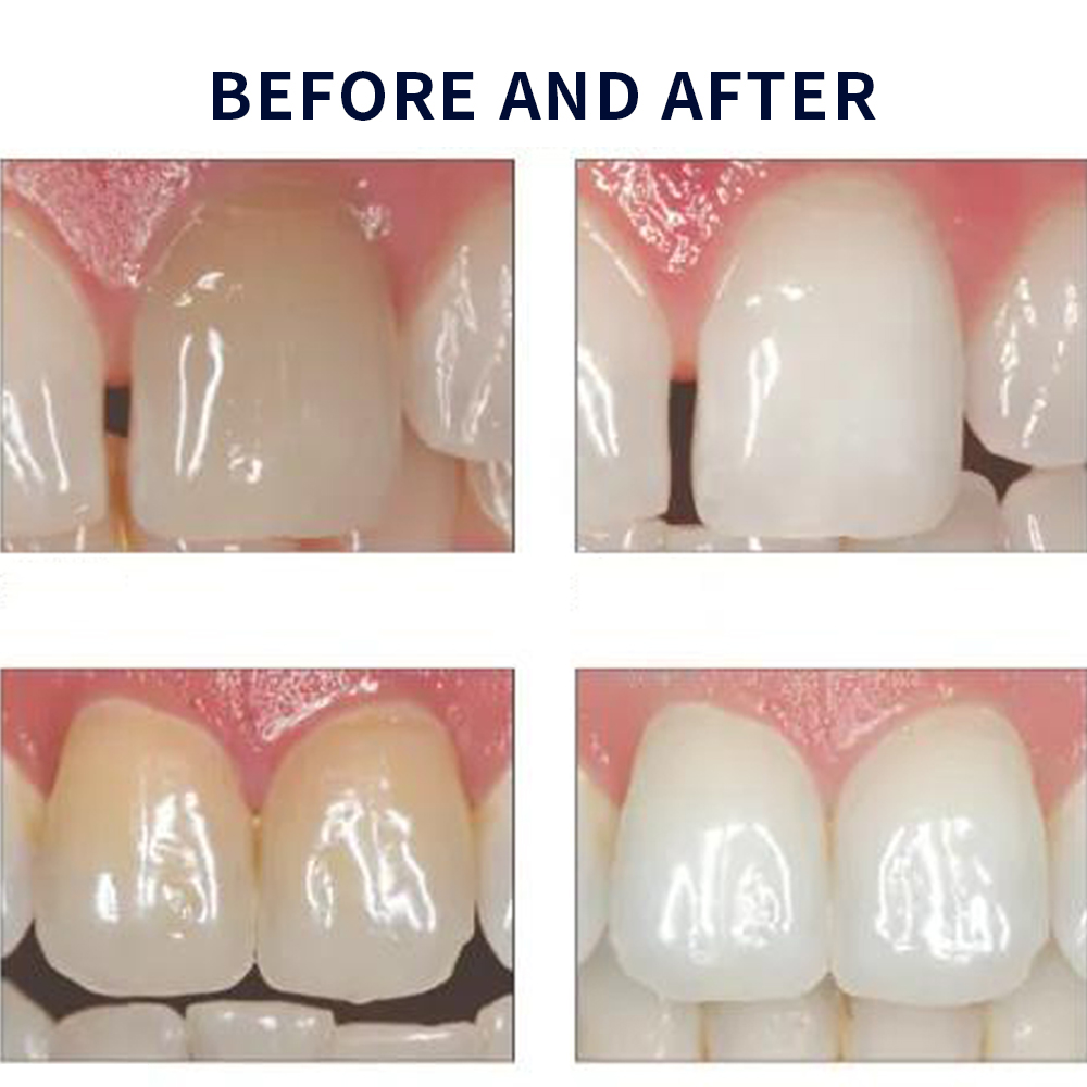 مجموعة جل تبييض أوباليزانس ، م - مراجعة Teeth Whitening Before And After وسعره