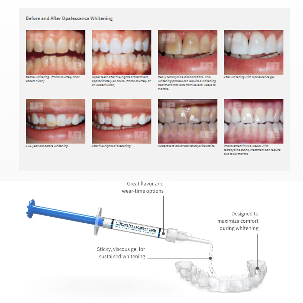 مجموعة جل تبييض أوباليزانس ، م - مراجعة Teeth Whitening Before And After وسعره