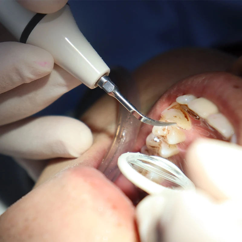 قشارة قبضة أنبوب كابل لوحدة ال - مراجعة Teeth Whitening Youtube وسعره