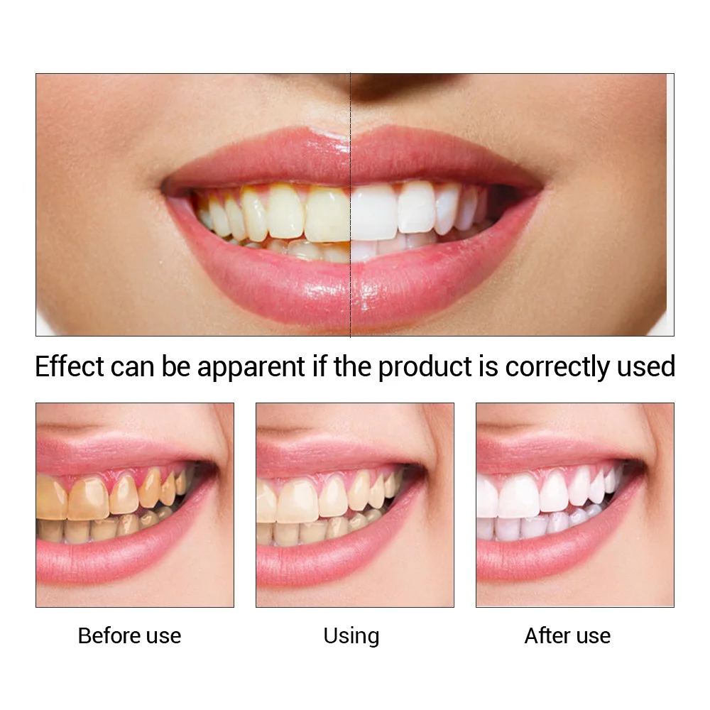 Fteenly تبييض الأسنان جوهر مسح - مراجعة Teeth Whitening Results وسعره