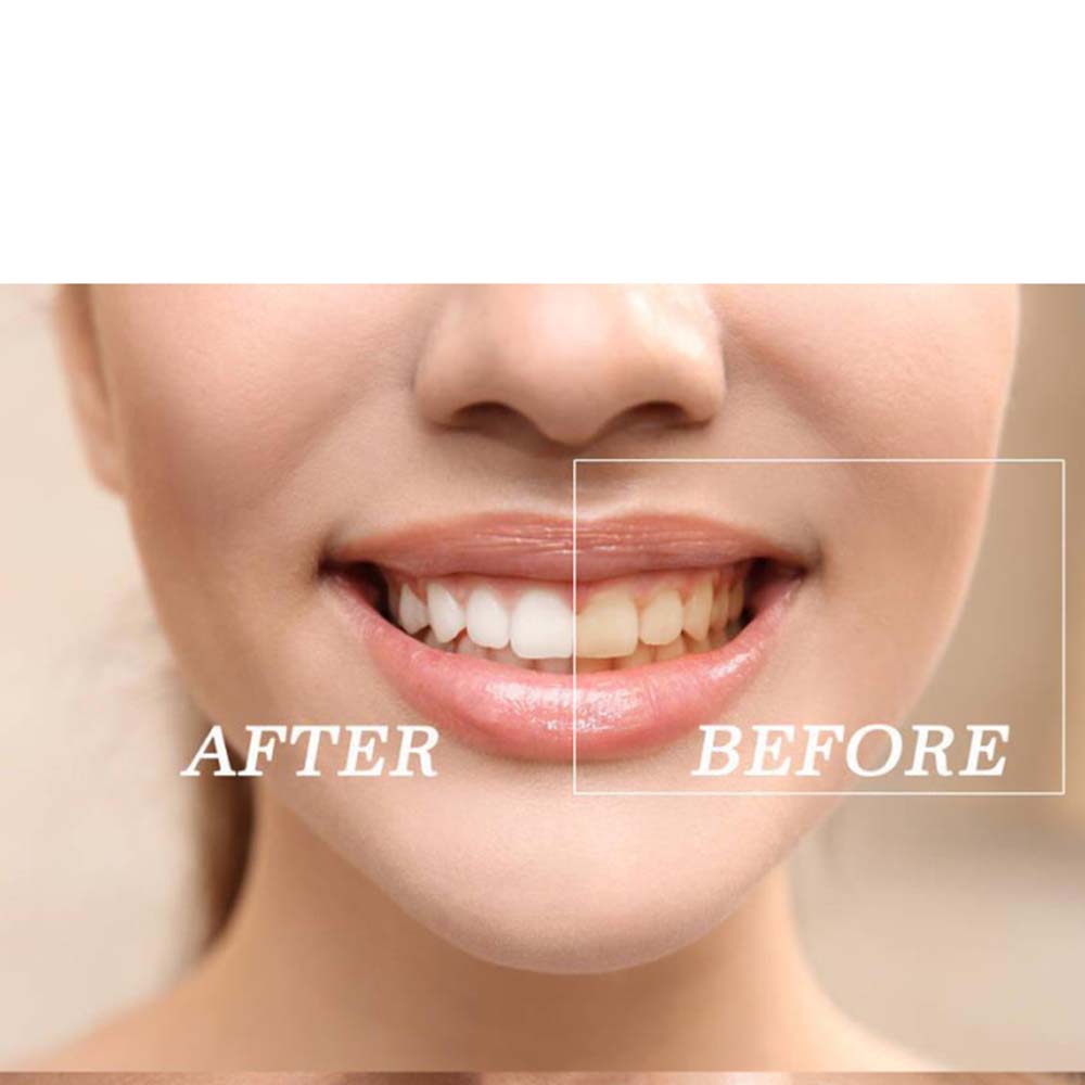 أعلى جودة بيروكسيد الأسنان تبي - مراجعة Teeth Whitening Kit وسعره