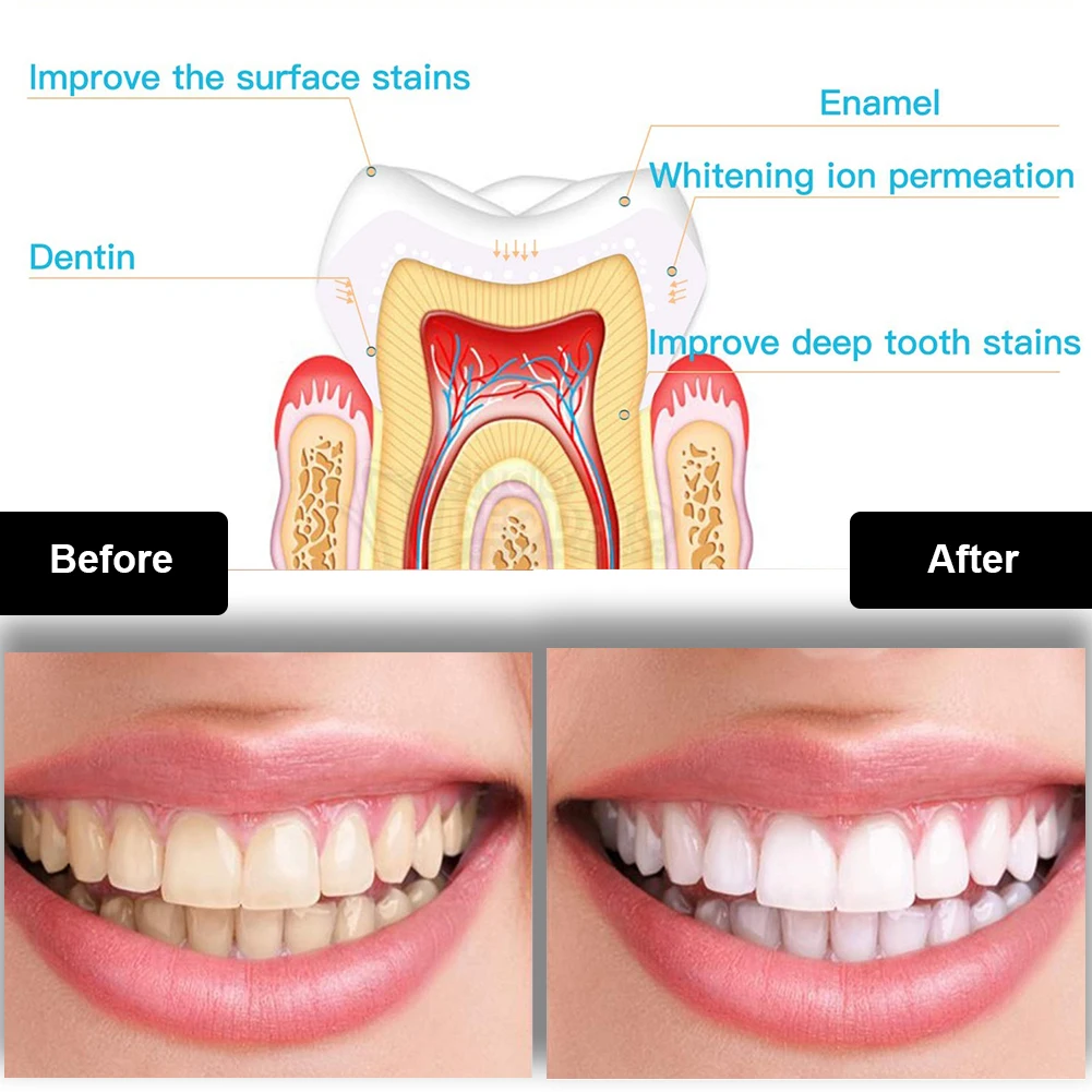طقم تبييض الأسنان صغير 16 LED  - مراجعة Teeth Whitening Before And After وسعره